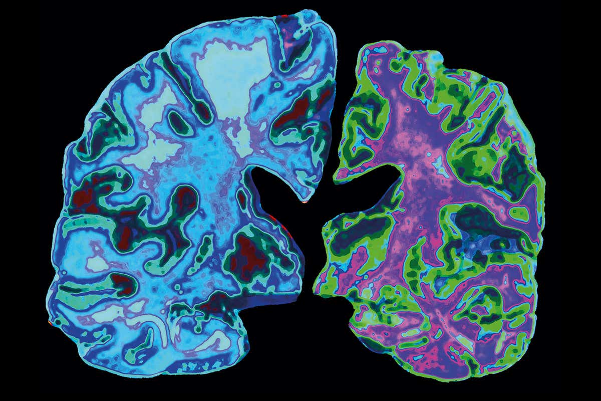 A Long Short-Term Memory Deep Learning Network for MRI Based Alzheimerâ€™s Disease Dementia Classification