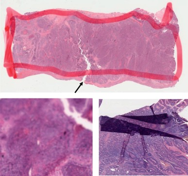 Histopathological Image  Analysis by using Machine Learning Methods