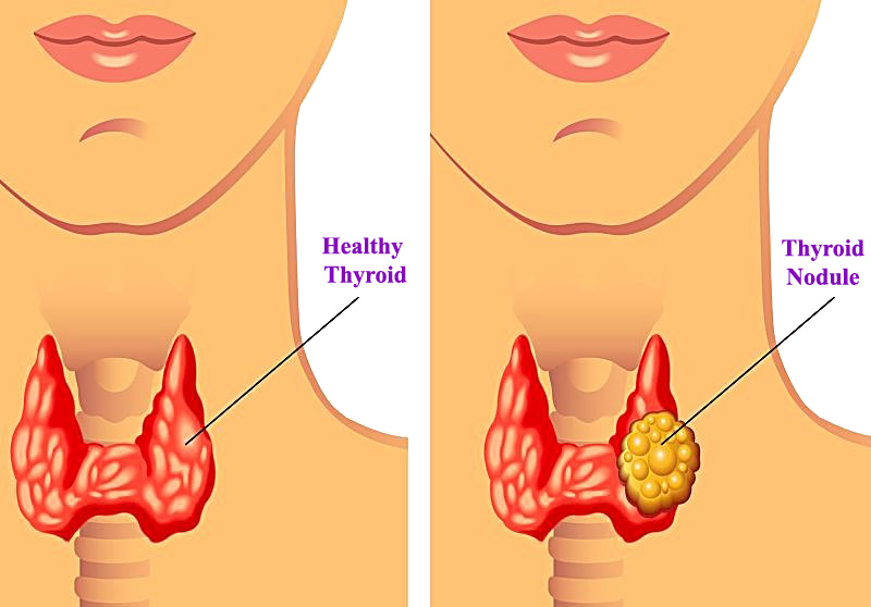 Thyroid Nodule is a Discrete Lesion in the Thyroid Gland