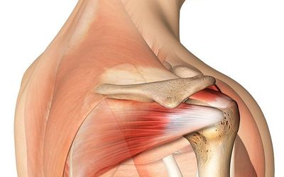 An Alternative Diagnosis of Shoulder Pain Visualized on Musculoskeletal Ultrasound: Deltoid Insertional Tendinopathy