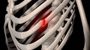 Real World Rib Fracture Patterns in Frontal Crashes in Different Restraint Conditions