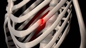 Real World Rib Fracture Patterns in Frontal Crashes in Different Restraint Conditions