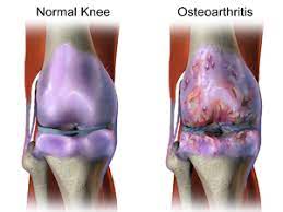 Effects of Bilateral Medial Knee Osteoarthritis on Intra and Inter Limb Contributions to Body Support during Gait