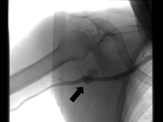 Vascular Injuries in the Upper Extremity in Athletes