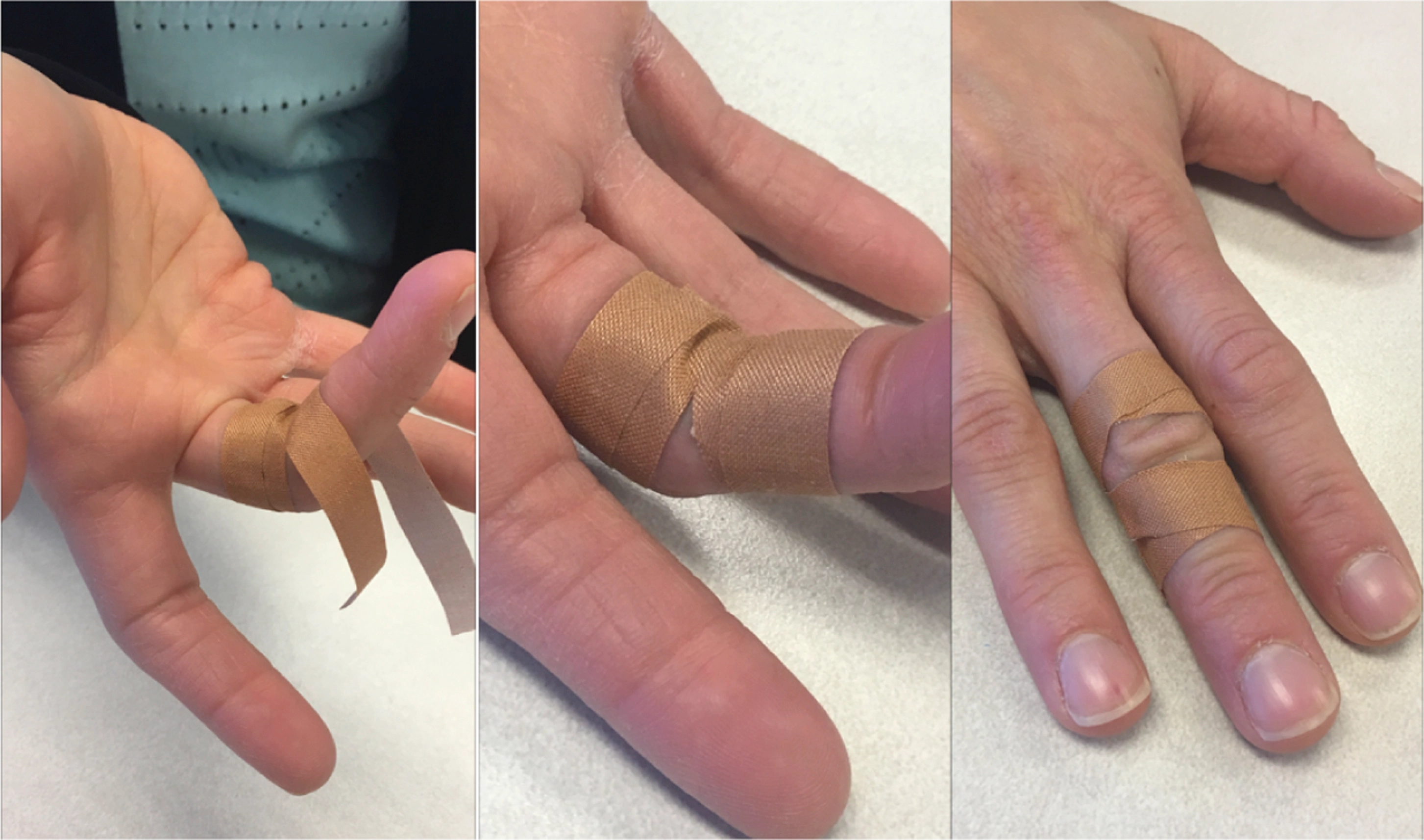 Finger Flexor Pulley Injury of Sport Climbers