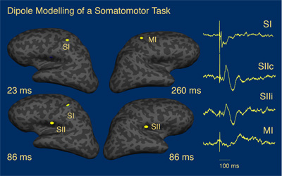 Evaluating Concussion in Sport: A Case for
Magnetoencephalography