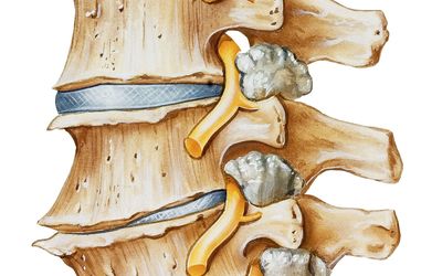 Rehabilitation and Return to Competition of a High Level Athlete with Spondylolysis and Contact Sport Related Recurrent LS Radiculopathy