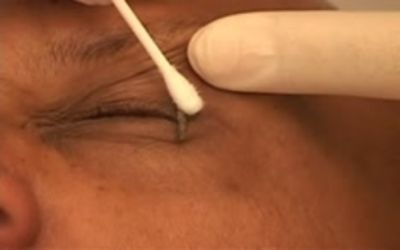 The Importance of Target Tissue Depth in Cryotherapy Application