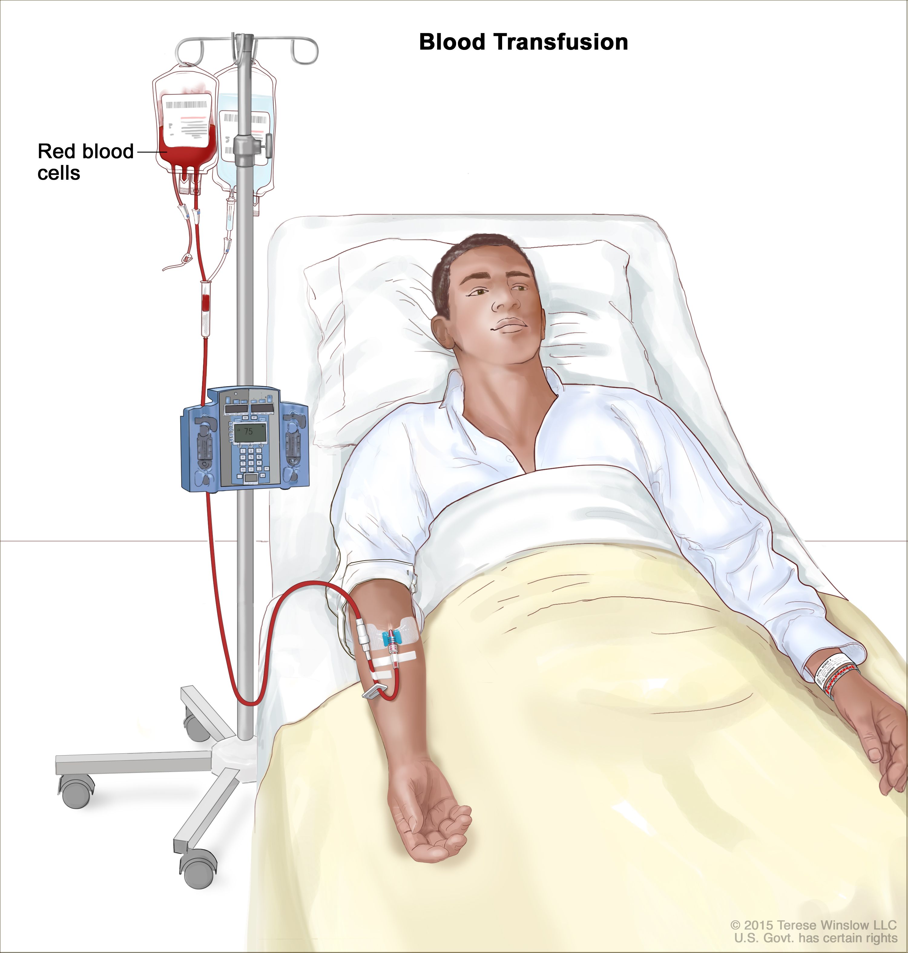 Pre-operative anemia can increase the risk of requiring a blood transfusion