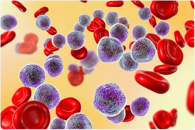 Causes and precautions ofLeukemia Cells