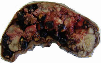 EHPVO and Splanchnic Vein Thrombosis