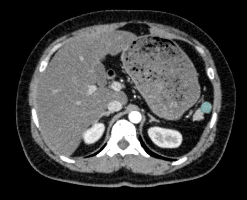 Accessory Spleen Only Detected Following Repeat Ultrasonographic Examinations: A Case Report