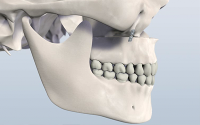 Modern Applications of Computer Bioengineering in Maxillofacial Surgery: Image
Guided Surgical Navigation and CAD/CAM Custom Implants