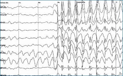 Dissimilarity of Graph Invariant Features from EEG Phase-space Analysis