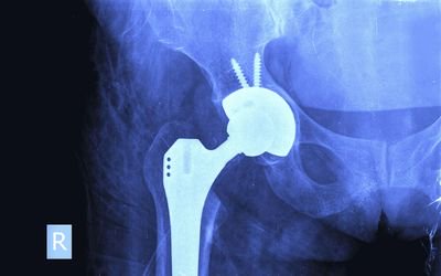 The Construction of the Anterior Pelvic Plane using
Landmarks Accessible in the Lateral Decubitus Position during Computer Assisted Hip Arthroplasty