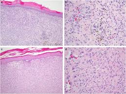 Histiocytomas are caused when Histiocytes Develop quickly and Produce More Histiocytes