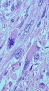 Leiomyosarcoma is a Harmful Tumor that Emerges from Smooth Muscle Cells