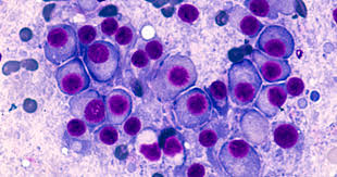 Different Myeloma is a Malignant Growth that Structures in a Sort of White platelet called a Plasma Cell