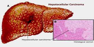 Hepatocellular Carcinoma is the most Well-Known Sort of Essential Liver Malignancy