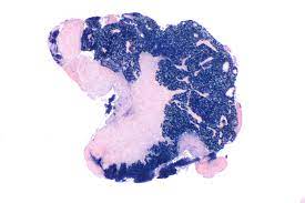 Nasopharyngeal Carcinoma is the most Well-Known Malignant Growth Starting in the Nasopharynx