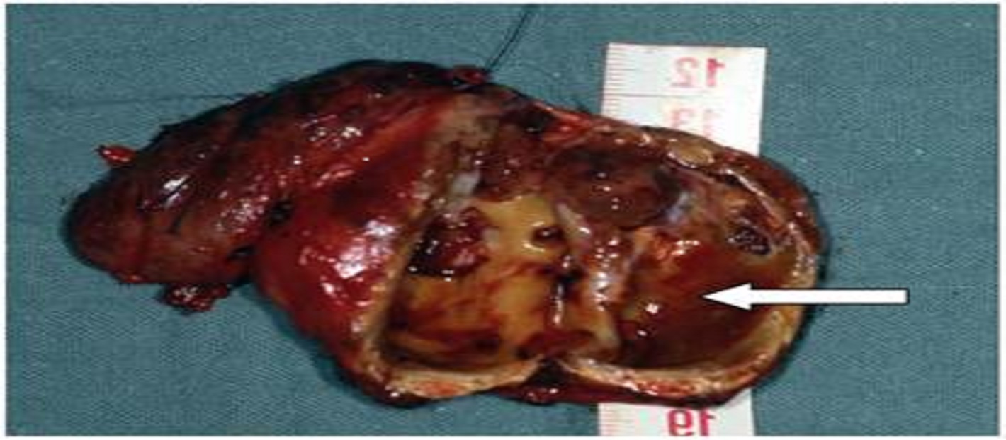 Chemoradiotherapy In Locally Invasive Parathyroid Cancer