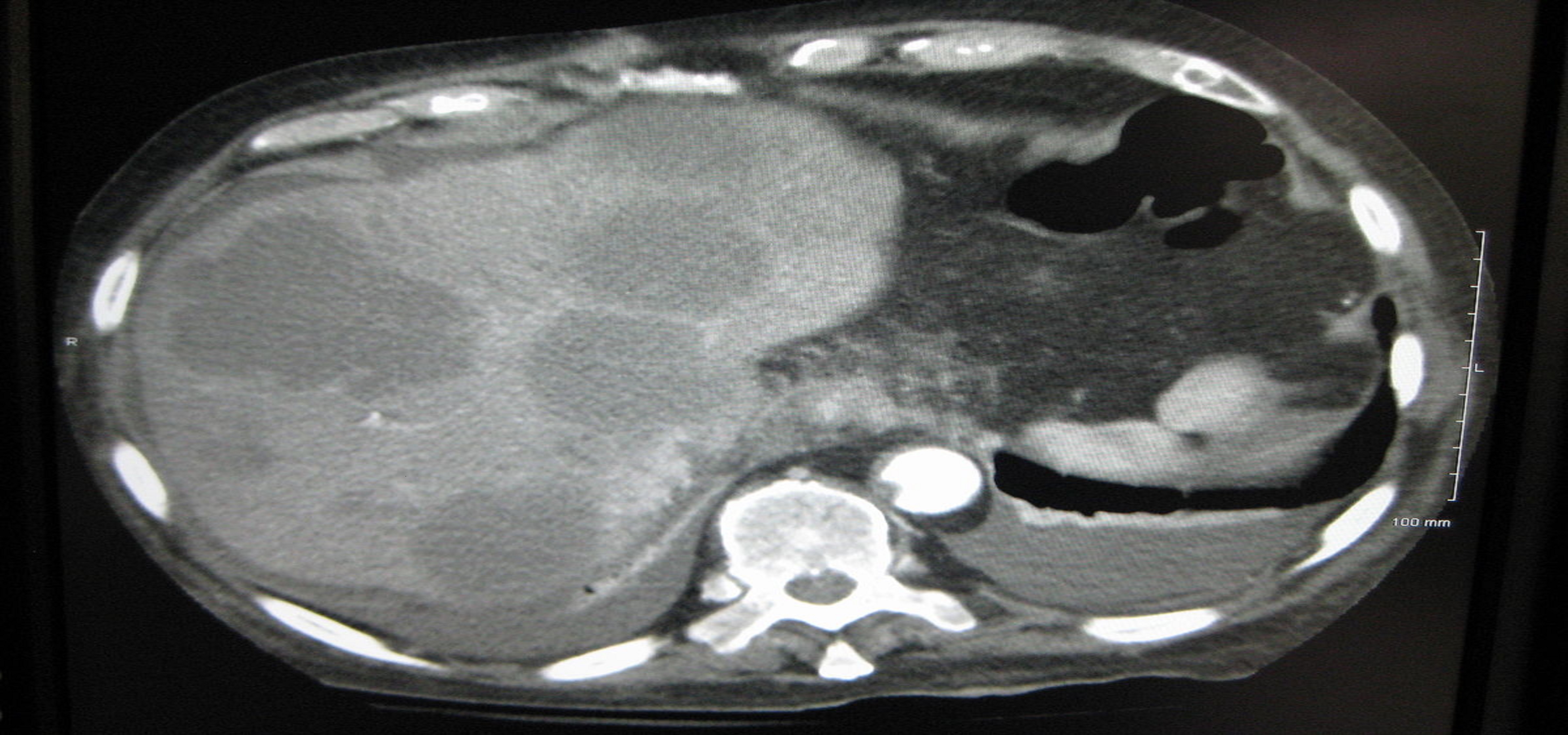 High Extra-Tumoral 99mTc-Macroaggregated Albumin Accumulation in a Fatty Liver in a Candidate for Transarterial Radioembolization Treatment