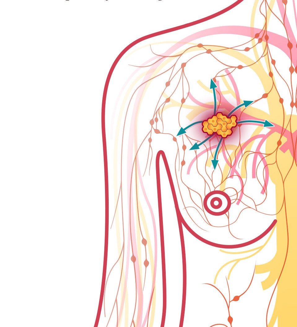 Influence of Abemaciclib, a New CDK 4/6 Inhibitor, Decrease in Potassium Electrollytes and Urea in a Patient Suffering from Metastatic Breast Cancer