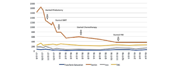 Iron Overload in the Setting of H63D Gene Mutation and Inrahepatic Cholangiocarcinoma