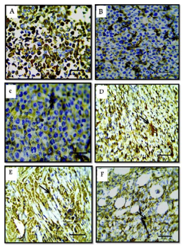 Safe Combination of Cisplatin
and Metformin Reverts the
Malignant Ascites in a Mouse
Model to a Solid Tumor by
Downregulation of Î”Np63 and
Induces Tumor Dormancy via m
TOR/ p21 Mechanism