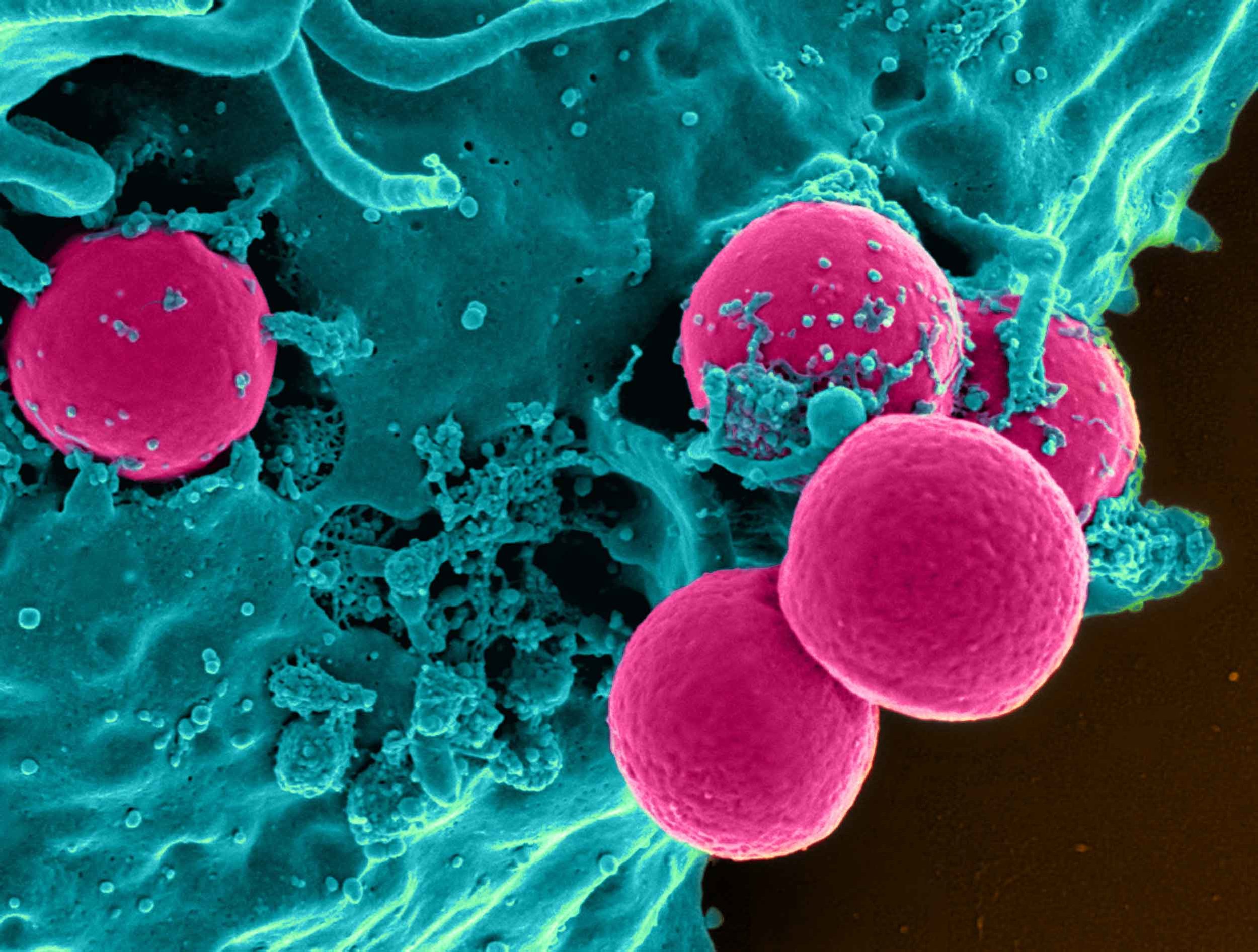 A neoplasm can be brought about by an unusual multiplication of tissues, which can be brought about by hereditary changes