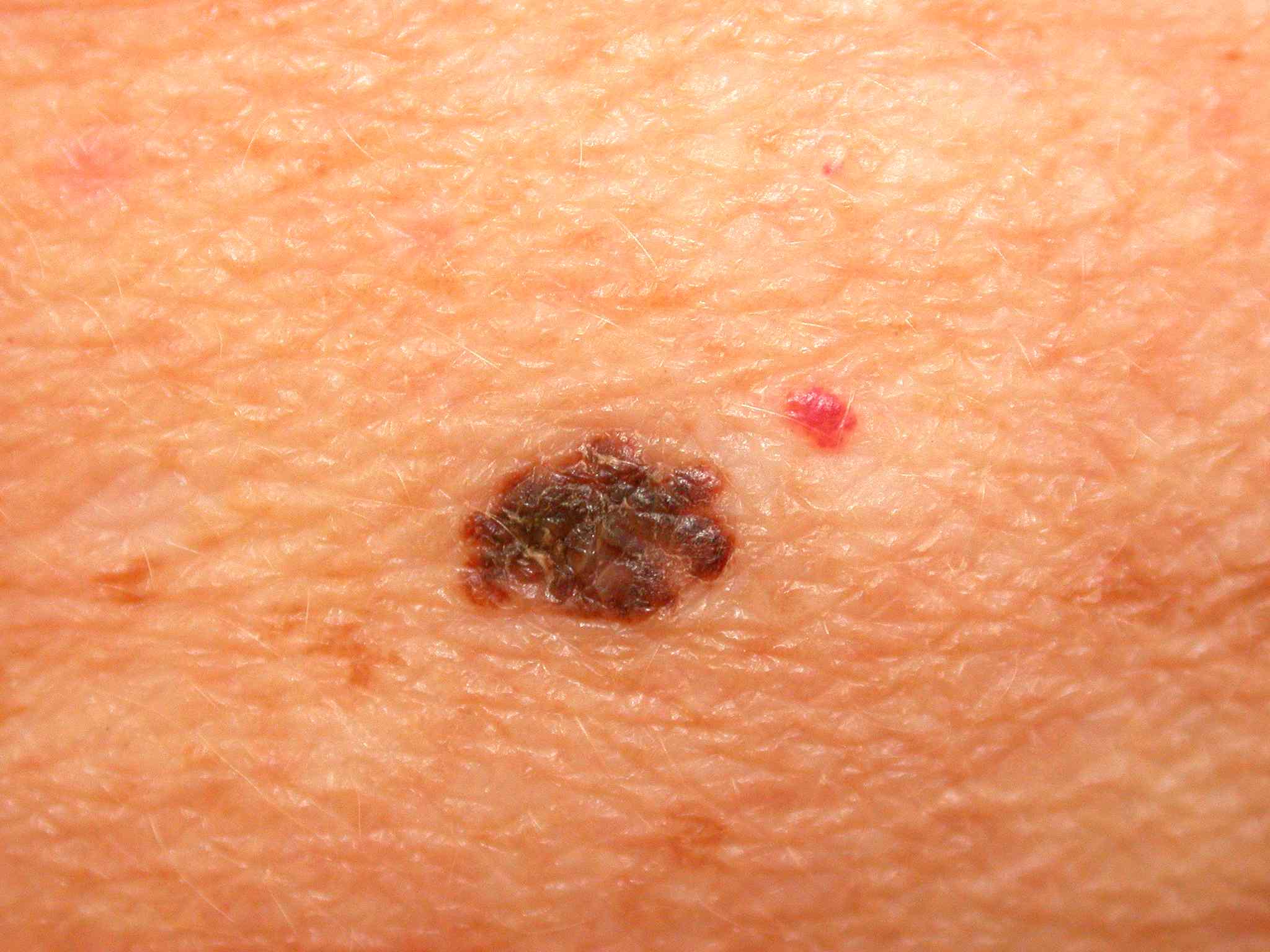 Melanoma is substantially less basic than some different kinds of skin malignant growths