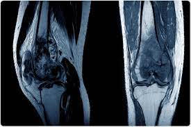 Osteosarcoma is a sort of bone malignancy that starts in the cells that structure bones