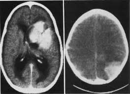 A few neuroblastomas develop and spread rapidly, while others develop gradually