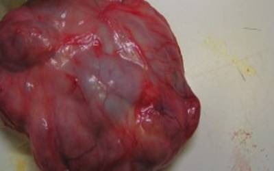 Solitary Fibrous Tumour of the Sinonasal Cavity-Case Report of Endoscopic Resection Using Coblation