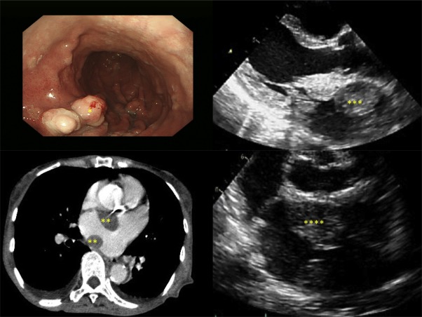 A Case of Dedifferentiated Liposarcoma of the Heart and Stomach