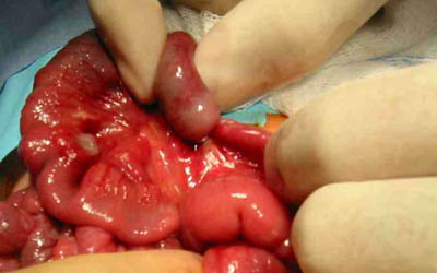 Small Intestinal Obstruction due to Metastasis from Marjolins Ulcer: Report of a Case and Review of the Literature