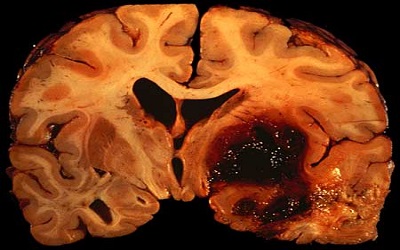 Choriocarcinoma Presenting as Intracerebral Haemorrhage and No Evident Primary: Rare Presentation