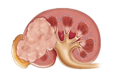 Correlation between the Presentation of Renal Cell Carcinoma and its Prognosis