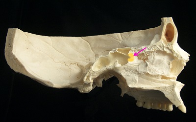 Diagnostic and Therapeutic Challenges in IgG4-Related Disease in the Sphenoid Sinus