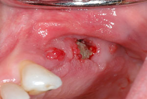 Giant Mucoepidermoid Carcinoma of the Parotid Gland: A Case Report and Review of Literature