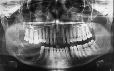 Challenges in Diagnose and Management of Ameloblastic Carcinoma: A Report of Three Cases