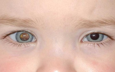 External Beam Radiation Therapy for Retinoblastoma
Resistant to Chemotherapy and Focal Treatment: Outcome and Predictive Factors