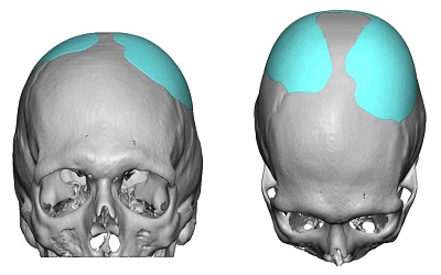 Evaluation of Automatic and Manual Contouring of Cranial Structures
