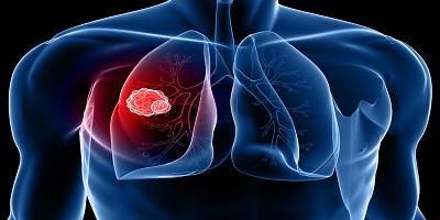 Biomarkers Can Promote Risk Stratification in CT Scanning for Lung Cancer Detection