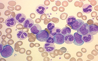 Highly Complex Chromosomal Rearrangements in Patients with
Chronic Myeloid Leukemia: An Indian Experience