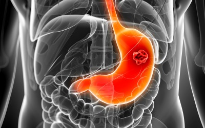 A Methylation Profile of Circulating Cell Free DNA for the Early Detection of Gastric Cancer and the Effects after Surgical Resection