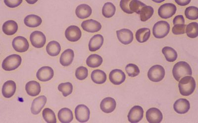 Tumor Infiltrating Lymphocyte and Axillary Lymph Node Positivity: A Systematic Review