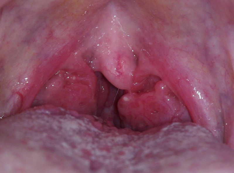 Schwannoma of the Palatine Tonsil: A Rare Entity in an Eight Year Old Girl