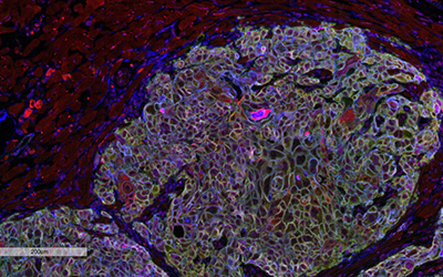 The Role of MicroRNAs in Cancer Progression