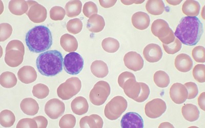 In vitro Study of Anti-Leukemic Potential of Ursolic Acid in Jurkat Cell Line